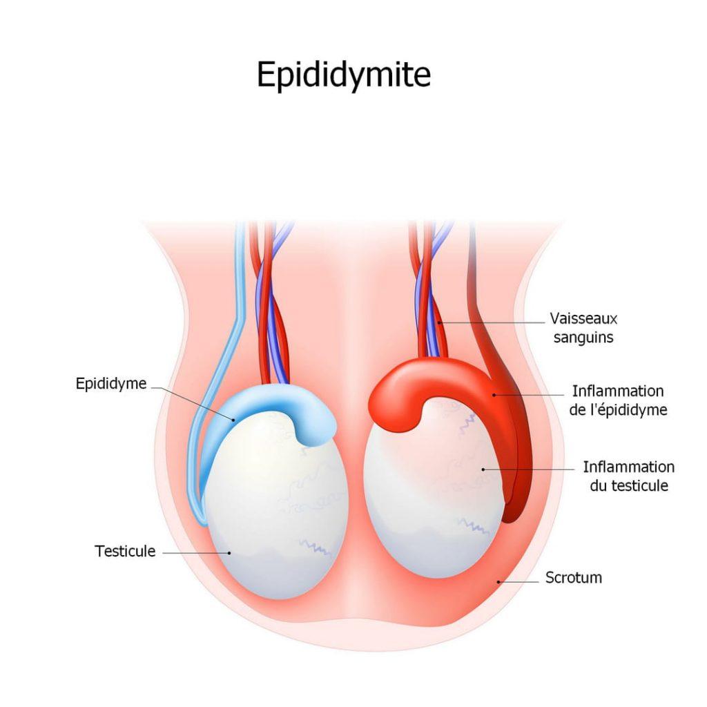Epididymite cause symptôme et prévention