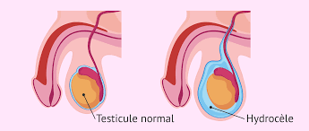 Hydrocèle vaginale