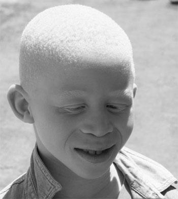 L'albinisme causes symptomes et traitement.