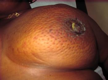 Cancer de sein causes symptôme et traitement