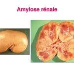 Amylose rénale cause symptôme et facteur de risque