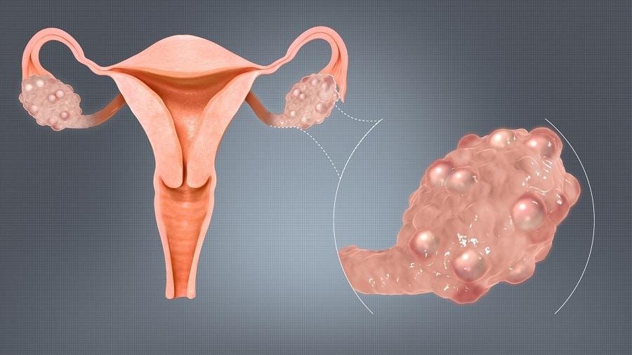 Dystrophie ovarienne cause et symptôme