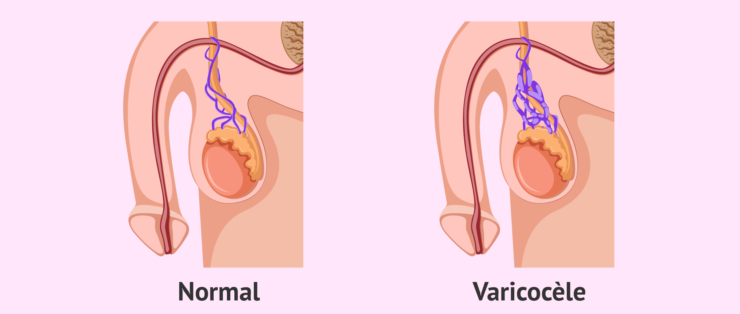 Varicocèle infertilité masculine.