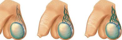 Causes atrophie testiculaire remède naturel .