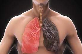 Cancer du poumon présentation .