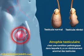 Causes atrophie testiculaire remède naturel .